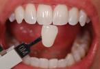 In-Office-Whitening-After-Image