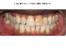 Porcelain-Veneers-Before-Image