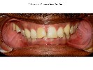 All-Ceramic-Crowns-Before-Image