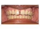 Cosmetic-Bonding-Before-Image