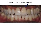 Porcelain-Veneers-After-Image