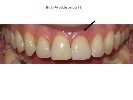 Porcelain-Veneers-After-Image