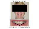 Porcelain-Veneers-Before-Image