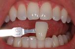 In-Office-Whitening-Before-Image