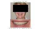Porcelain-Veneers-After-Image