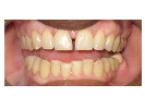 Cosmetic-Bonding-After-Image
