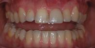 Replacing-a-Single-Front-Tooth-With-An-Implant-After-Image