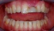 Replacing-a-Single-Front-Tooth-With-An-Implant-Before-Image